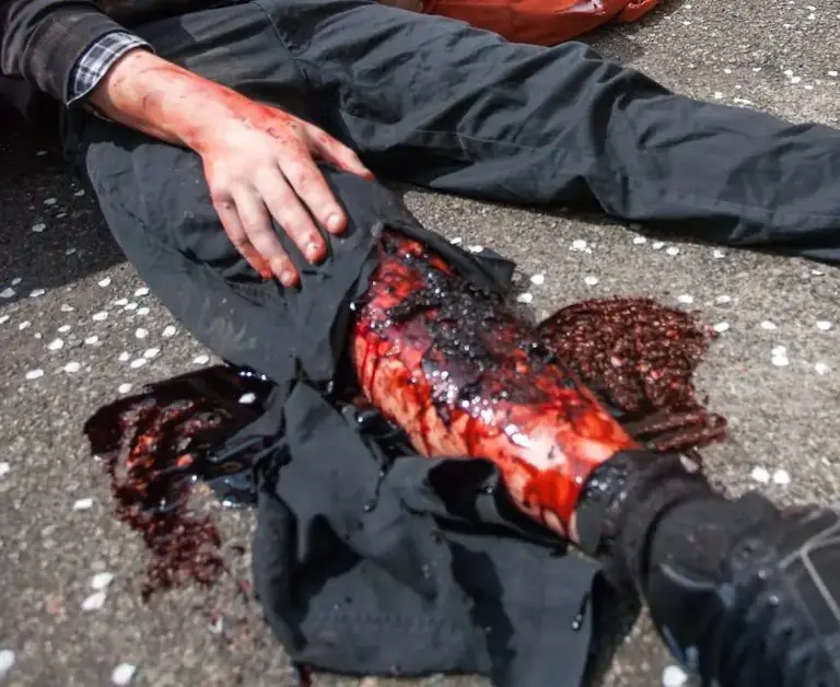 Erste Hilfe bei starker Blutung: Druckverband am Unterarm wird angelegt